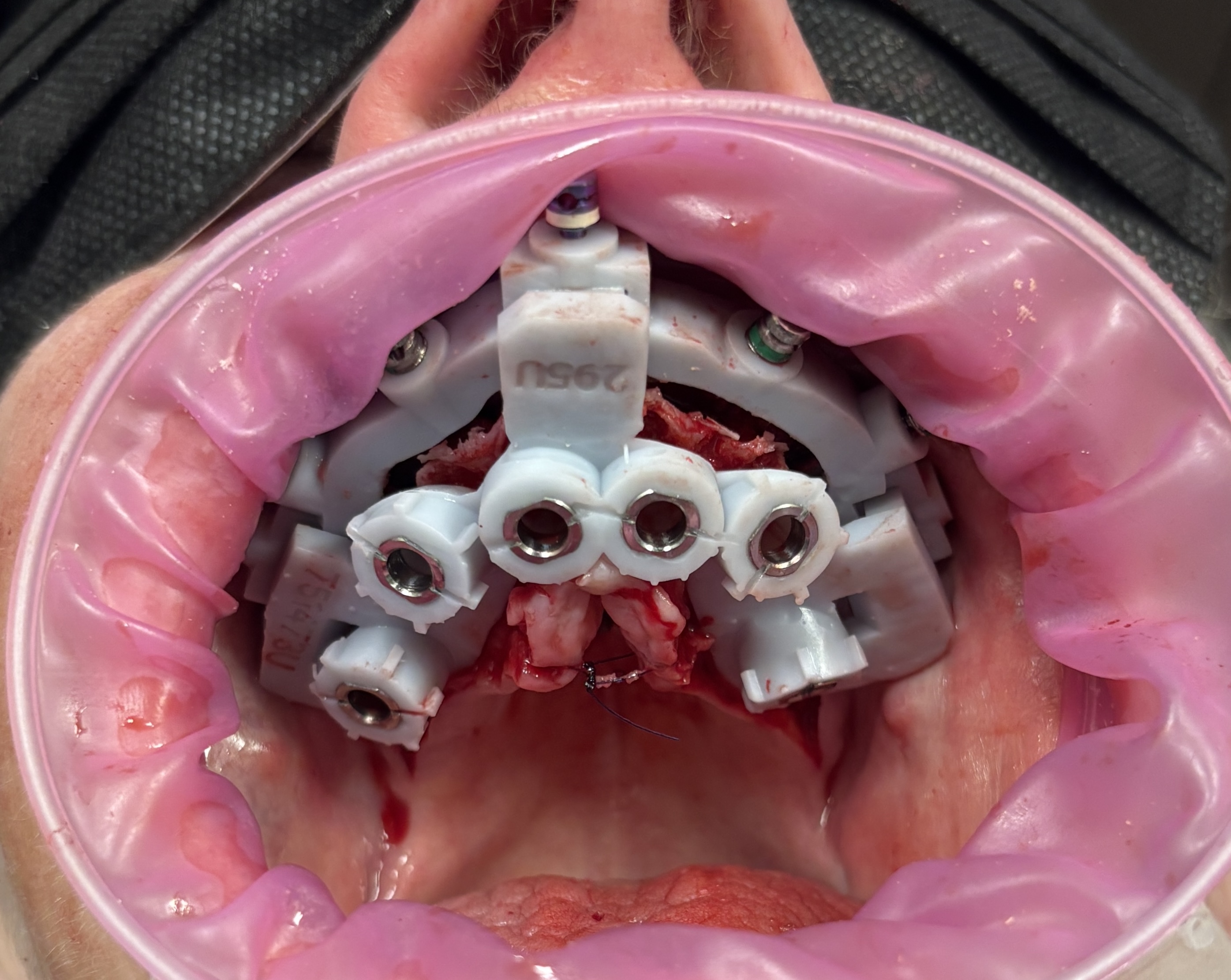 健康・医学 Ultimate Guide IMPLANTS CombiGuide™